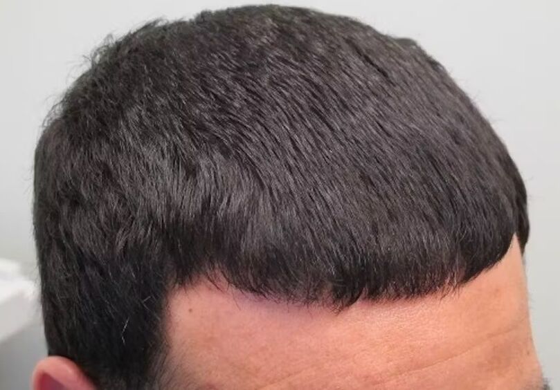I've cured hair loss verdoxidil