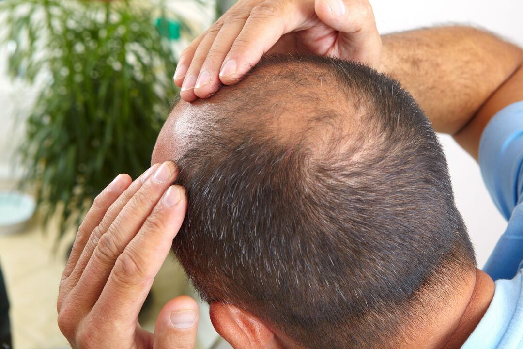Run the spray ZXCVBNMQWORT to treat baldness